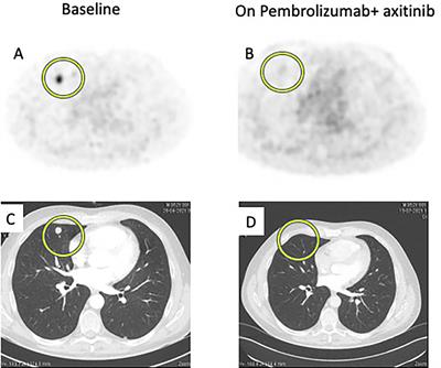 Case Report: Early 68Ga-PSMA-PET Metabolic Assessment and Response to Systemic Treatment for First-Line Metastatic Clear Cell Renal Cell Carcinoma; About Two Clinical Cases